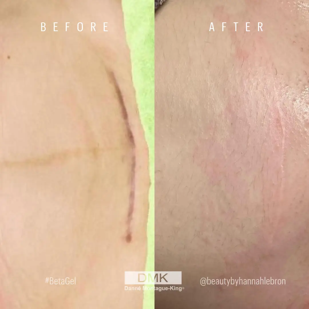 @beautybyhannahlebron DMK Difference C-Section Scar Revision B&A