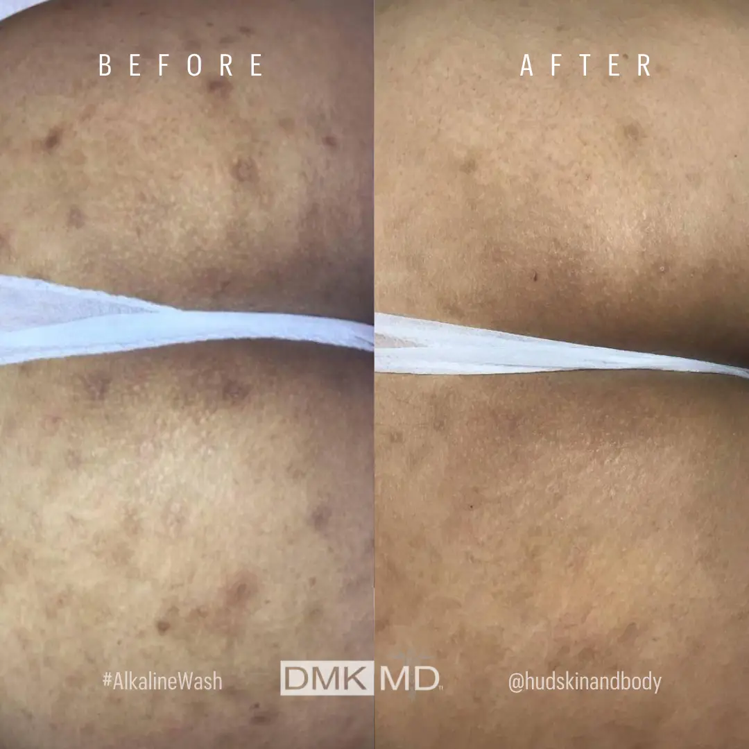 @hudskinandbody 2x Alkaline Wash and Body Enzyme - Folliculitis and Pigment B&A