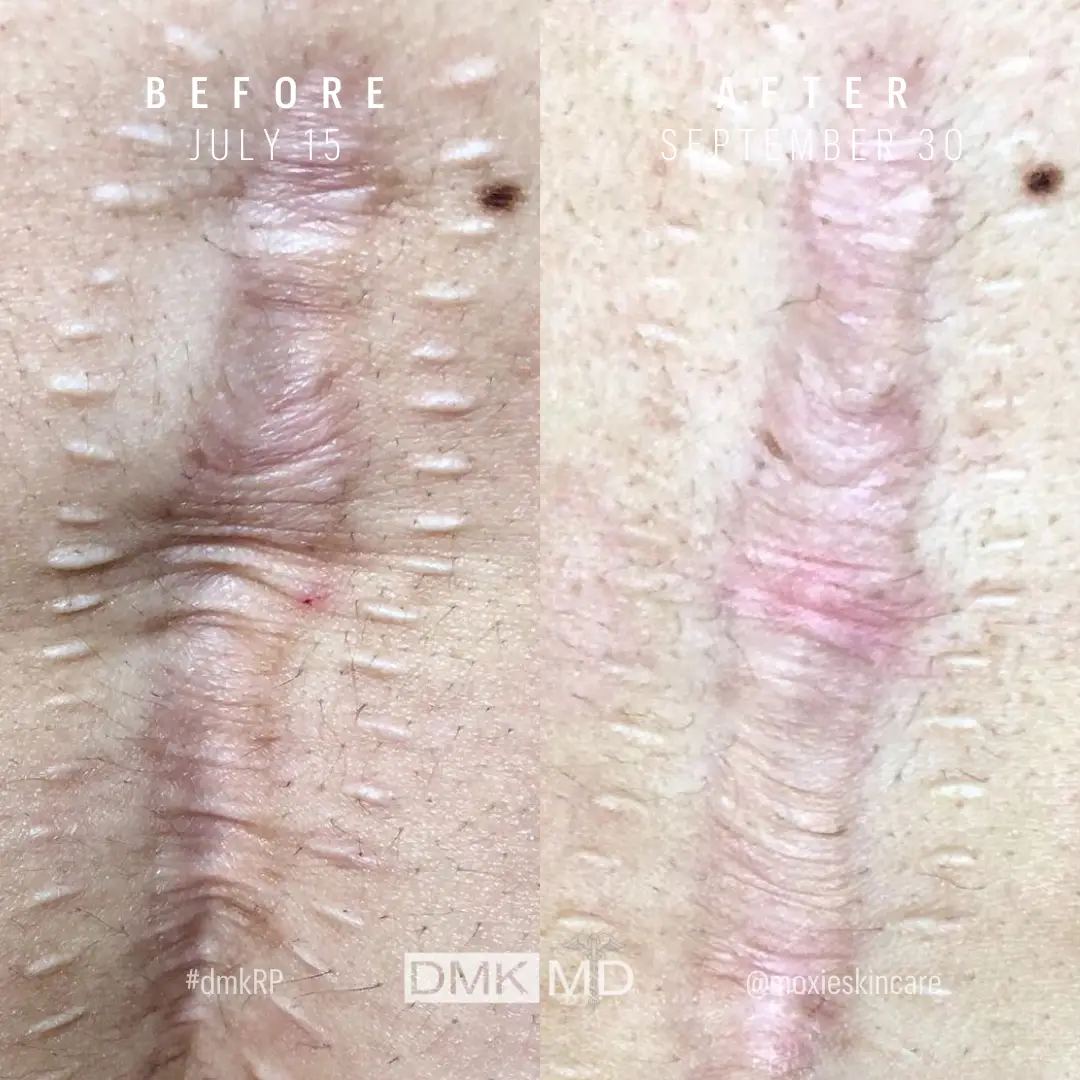 @moxieskincare Scar Revision with Body Enzyme 4x Treatments + 1 RP Peel