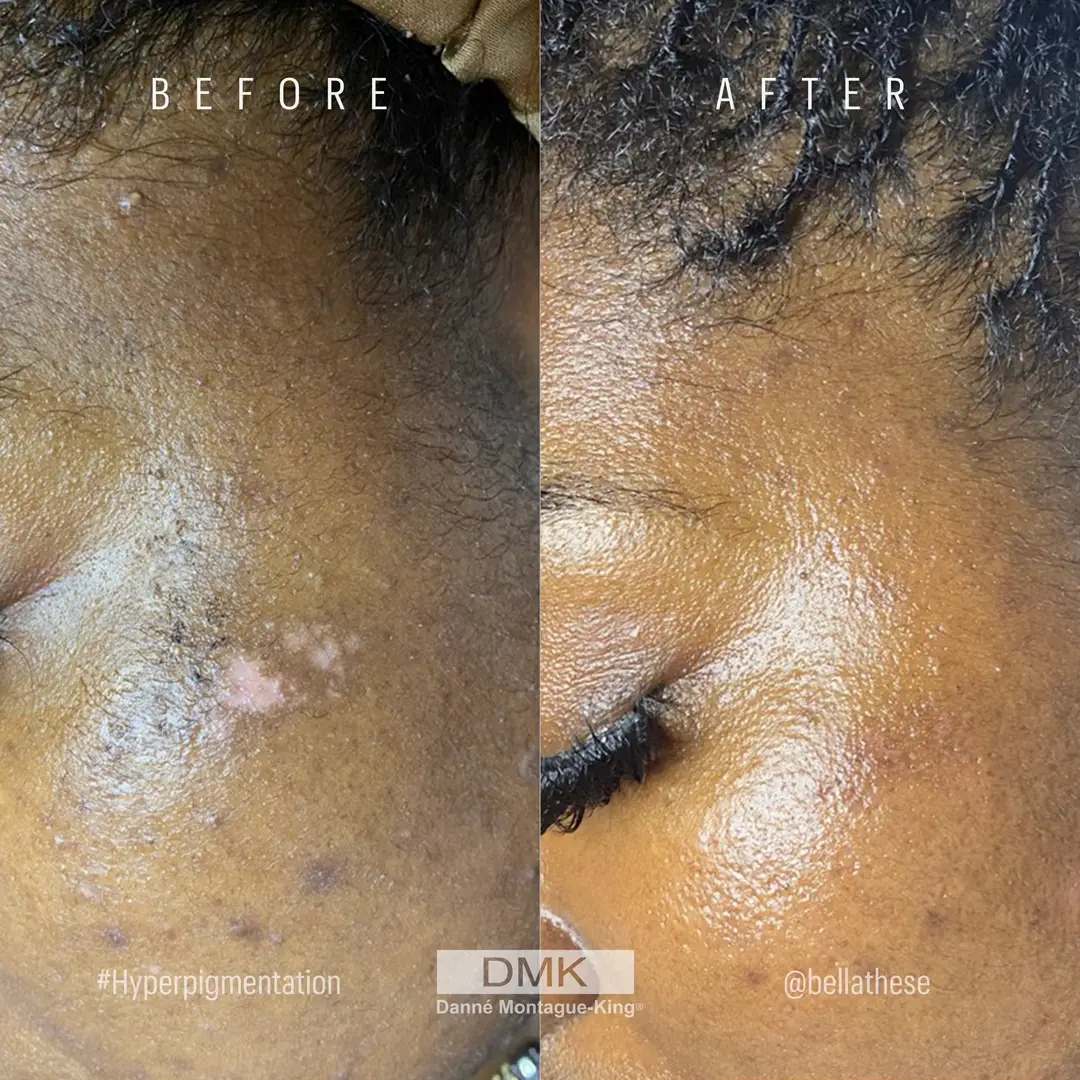 @bellathese_actrol+betagel_hyperpigmentation