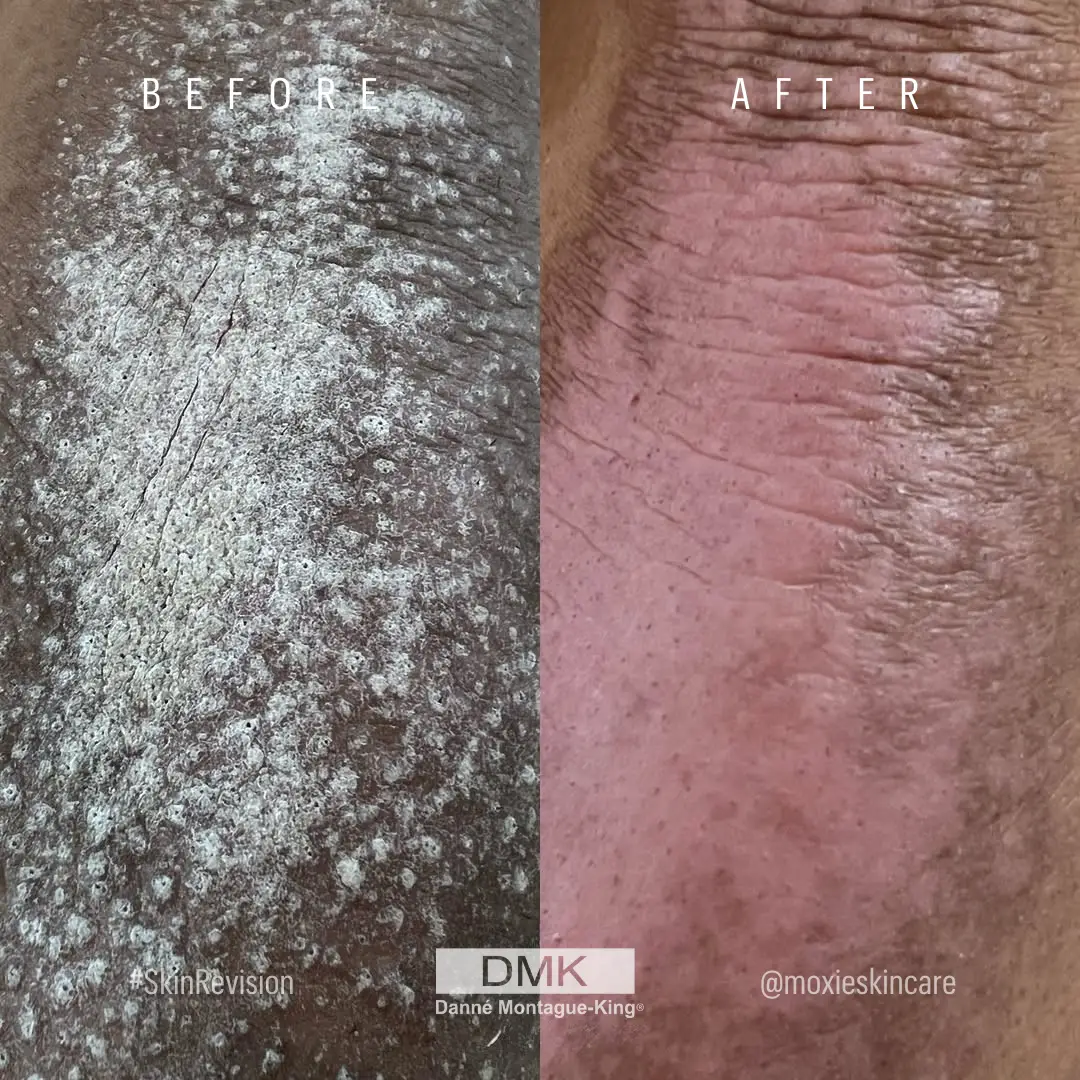 @moxieskincare Plaque Psoriasis B&A
